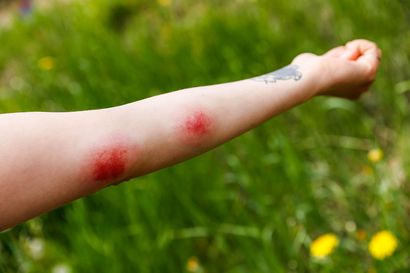 Näin pahaa jälkeä hyt­ty­sen­pu­re­ma voi ai­heut­taa al­ler­gi­kol­le – Pis­tos­ten oireet voivat kestää jopa viikon, eikä vaivaan ole siedätyshoitoa