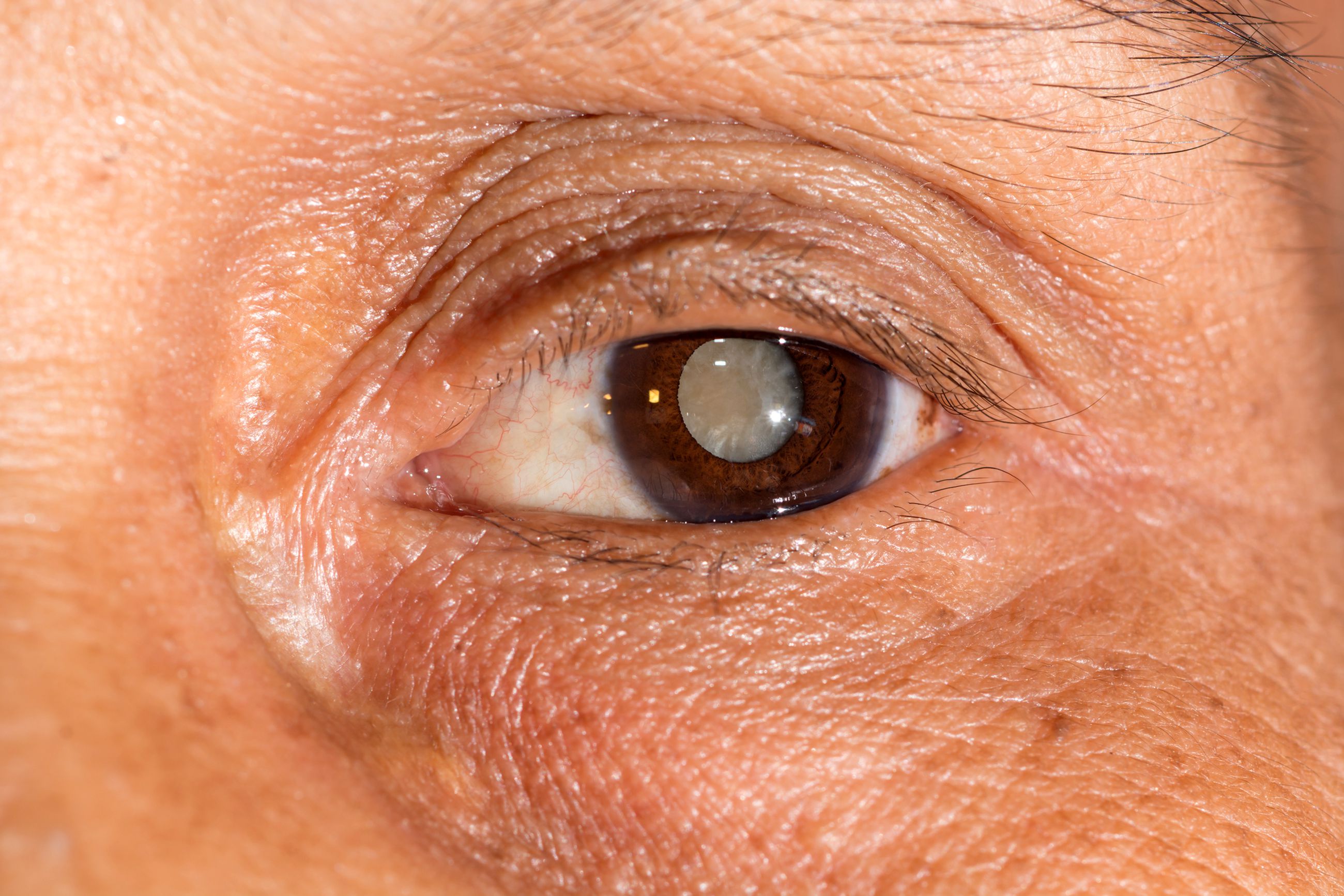 Зрение 1 симптомы. Сенильная катаракта глаза. Анатомия глаза катаракта.