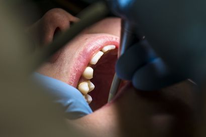 Raahessa on ollut koronapositiivinen hammaslääkärissä: jos kävit hammaslääkärissä ja sinulle tuli oireita, hakeudu testiin