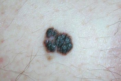 Diagnosoimatta jääneissä melanoomissa kytee terveyspommi